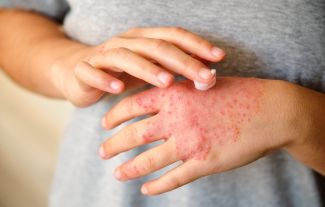 Ekzém může souviset s vaší negativitou, tvrdí psychodermatologie