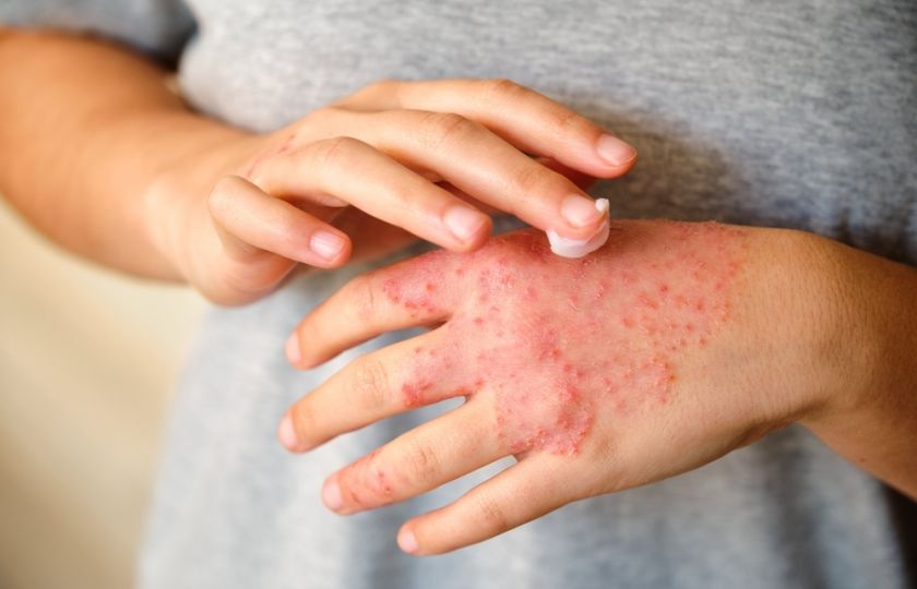 Ekzém může souviset s vaší negativitou, tvrdí psychodermatologie