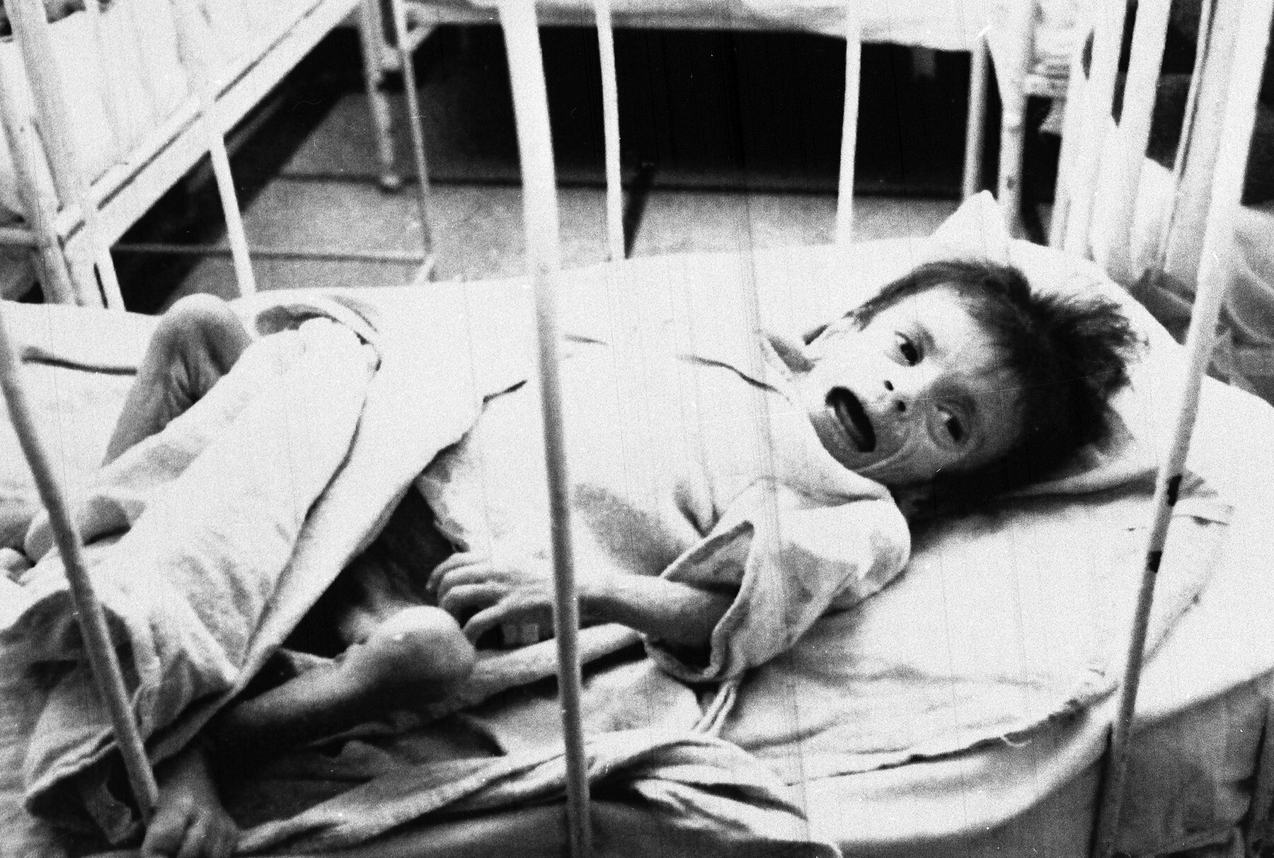 Rumunský sirotek, trpící AIDS, na uzavřeném oddělení nemocnice v Bukurešti v roce 1990. (foto: Profimedia) profimedia 0601323011